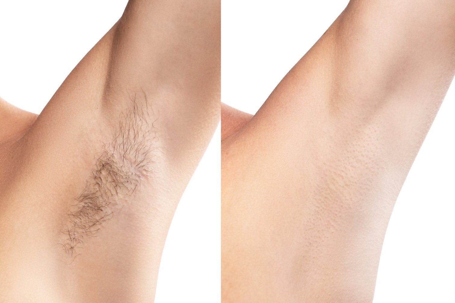 Comparison of Female Armpit after Hair Removal